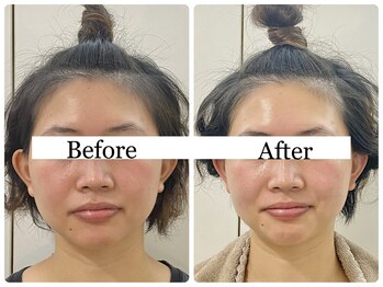 ウニカ(Unica)/BeforeAfter