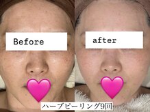 アリス(ALICE)/ハーブピーリングでツルツル肌へ