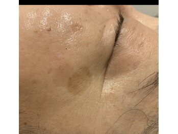 トゥーセブンネイルズ(TwoSevenNails)/くすみ、シミケア