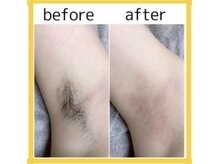 アルゴ 太田店(ALGO)/アルゴ式WAX脱毛＋光脱毛