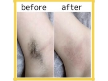 アルゴ 太田店(ALGO)/アルゴ式WAX脱毛＋光脱毛