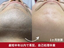 美容脱毛専門サロン エピラージュ 新宿店(Epilage)の雰囲気（元には戻りません。1回1回大切に脱毛します。自己処理不要へ！）