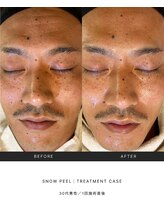 スキンラウンジ(SKIN LOUNGE)/韓国肌管理｜PDRN雪花ピール