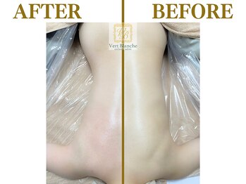 ヴェールブランシュ 町田(Vert Blanche)/#ブライダルエステ#痩身#背中