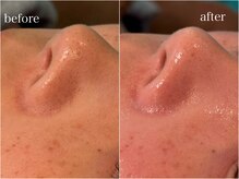 お鼻の黒ずみもつるんと綺麗に☆(陶肌ピール1回のbefore/after)