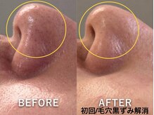 ラカ 明石(Laka)/鼻の黒ずみ・毛穴開き・イチゴ鼻