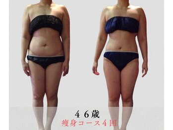 サンテボーテ(Sante Beaute)/モニター様　４回目（痩身）