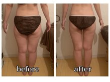 シェノン(CHAINON)/キャビテーション