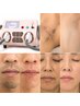 【リピーター続出コラーゲン脱毛】脱毛全身+顔orVIO 3500円