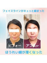 ビューティスタジオＫ/ホウレイ線がお悩みでした