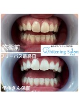 ホワイトニングサロン 熊本店/【ホワイトニング施術例】