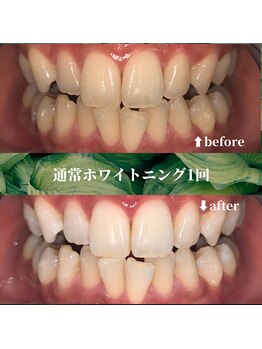 フタバ 天神大名店(futaba)/初回ホワイトニングbefore after