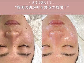 ラティーナ(Lattina)の写真/【韓国艶肌WAX×陶肌ピール×モデリングパック付】ダウンタイムなしで透明感あふれる艶肌へ♪