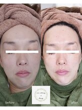 ココホワイトニング(coco whitening)/【TIPハーブピーリング】