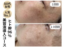 ディレイア ザ コスメ 有楽町マルイ店(direia the cosme)/しみ/くすみ/色ムラ[有楽町]