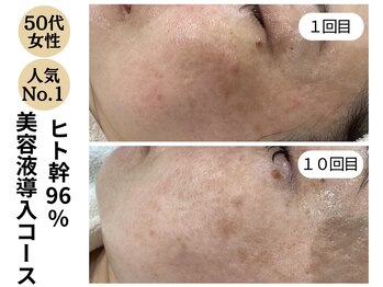 ディレイア ザ コスメ 有楽町マルイ店(direia the cosme)/しみ/くすみ/色ムラ[有楽町]