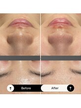 ホイップスパ(WHIP SPA)/毛穴洗浄【1度の効果】