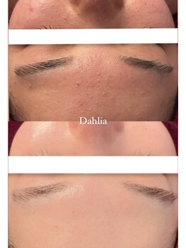 ダリア(Dahlia)/コメド肌→陶器肌へ！