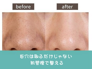ココミエレ(COCO MIELE)の写真/鼻の毛穴対策はハイドロで徹底ケア！つるんとクリアな素肌へ導くエステ体験♪