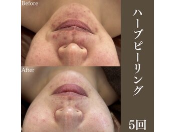 サロンドペシェ(salon de peche)/30代/隠したい繰り返すニキビに
