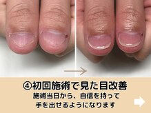 ブルームーンネイルズ(BLOOMOON.nails)/初回施術で見た目改善が可能です
