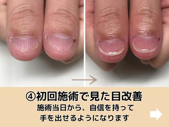 ブルームーンネイルズ(BLOOMOON.nails)/初回施術で見た目改善が可能です