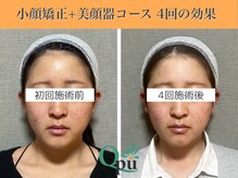 キュープ 表参道店(Qpu)/美顔器モニターコース4回の変化
