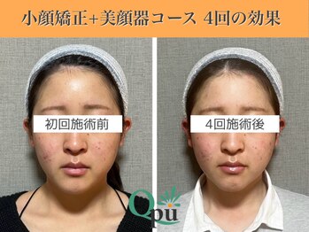 キュープ 表参道店(Qpu)/美顔器モニターコース4回の変化