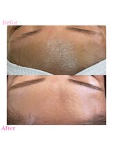 プリュスマイル(+Smile.)/おでこワックス×眉毛ワックス