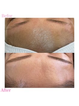 プリュスマイル(+Smile.)/おでこワックス×眉毛ワックス