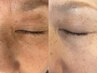 【しみケア年齢肌】最新美容プラズマ100分※30分以上前のご予約 22000→19800