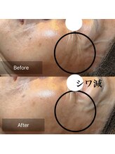 フルブルーム(Full Bloom)/ララピール/シワ改善/１回の施術