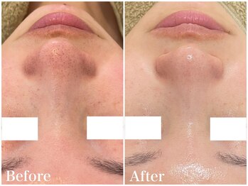 サロンドフェイス(Salon de Faith)/【ハーブピーリング】4回施術♪