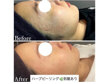 マドモアゼル 麻布十番/ハーブピーリング