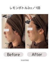 なごみ/脂肪分解【レモンボトル】