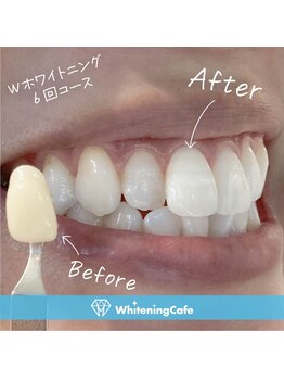 ホワイトニングカフェ 千葉店/ホワイトニングビフォーアフター