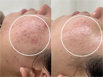 アンリミット 原宿竹下通り店(Une limit)/【ノーファンデに向けて！】