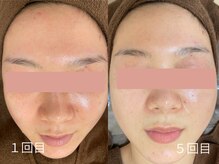 エミルカ 日の出平井店(EMILUCA)/トーンUP！！明るい素肌へ♪