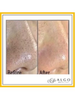 アルゴ 太田店(ALGO)/いちご鼻卒業！毛穴洗浄＋光脱毛