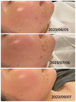 ハーシークレット(Her secret)/ハーブピーリングDT有・経過