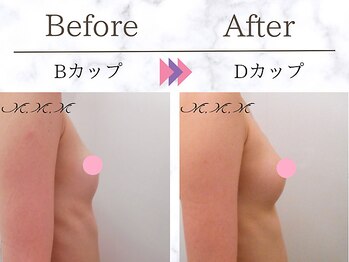 メディカルサロン エム エム エム 心斎橋本店(M.M.M)/【バストアップ例】　B→Dカップ