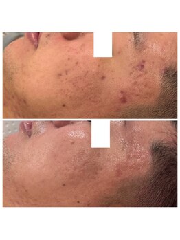 メンズフェイシャル