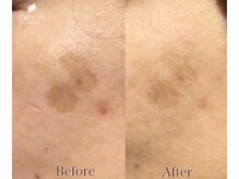 トリンテ バイ フェース(TRINTE by FAITH)/【光フェイシャル】6回(3週間隔)