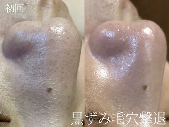 フォア(foi)の写真/肌悩みNO.1『 毛穴』に効果を出す