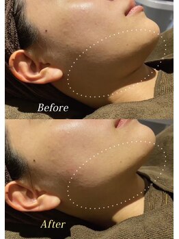 アネル 宮古島店(anel)/3D超音波before→after