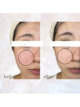 ビスイ 恵比寿(Bisui)/ハーブピーリング/毛穴/毛穴ケア