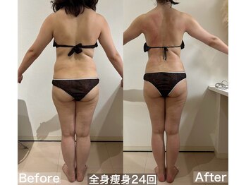 ヴィクシア(VIXIA)/痩身90分