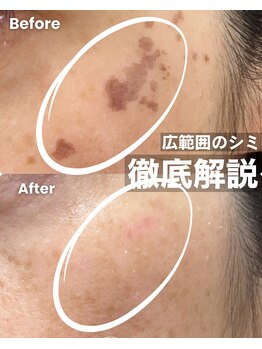 イデアーレ(ideale)/40代・本気のシミケア