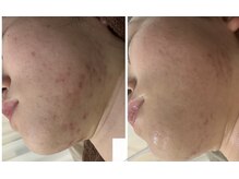 ホワイトアクア 京橋店(WHITE AQUA)/ニキビ6回ビフォーアフター