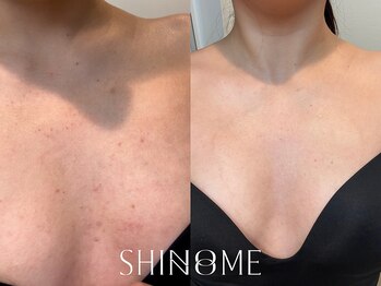 シノノメ(SHINONOME)/デコルテニキビ